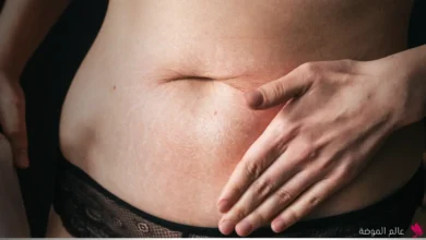 علامات التمدد